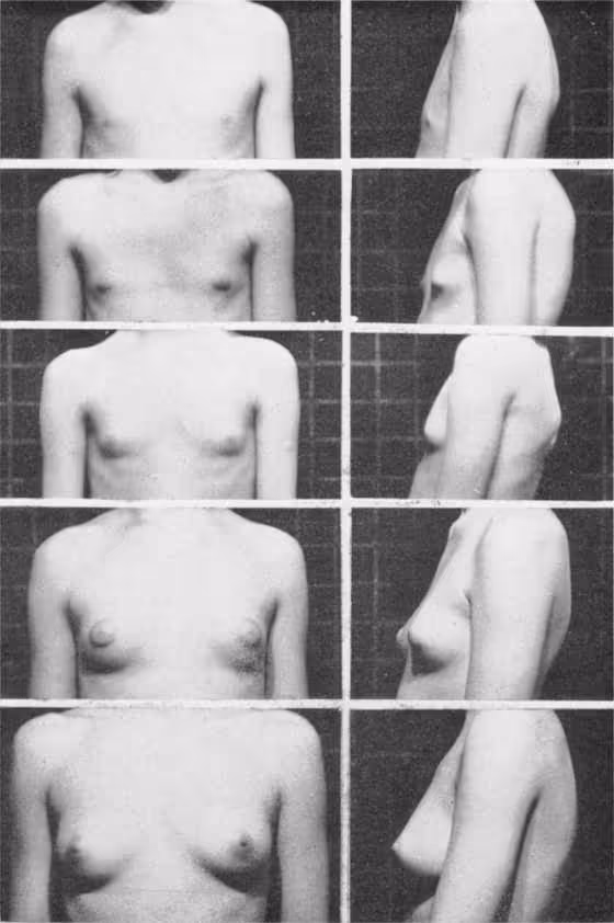 图 5 乳房发育的五个阶段