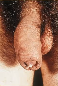 图 1 淋病导致的男性尿道出现脓状排泄物