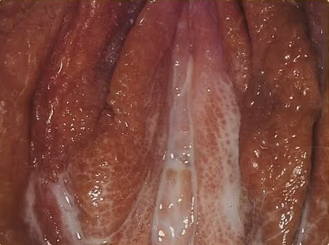 图 2 淋病导致的女性阴部排泄物