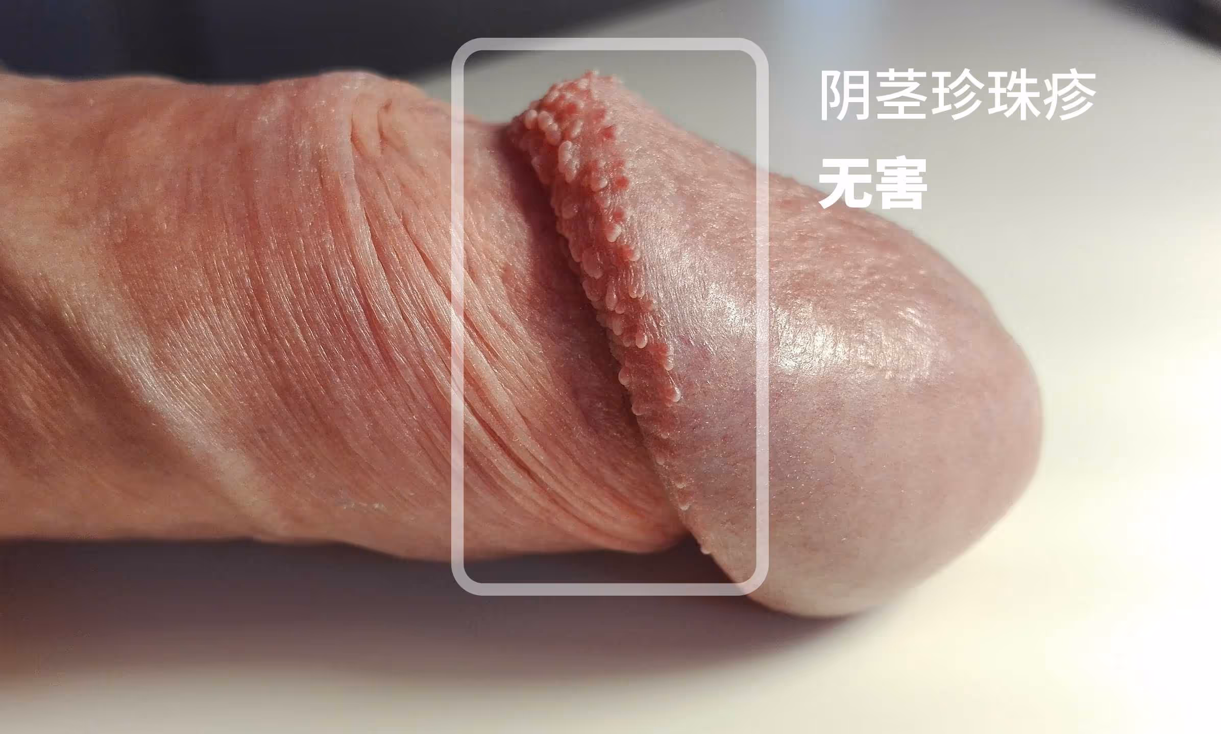 图 3 阴茎珍珠疹(无害)