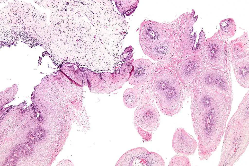尖锐湿疣 Genital Wart